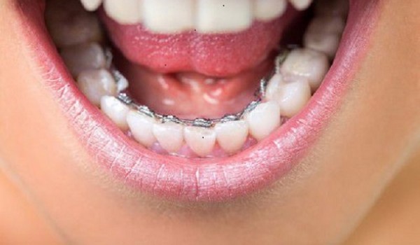 Phương Pháp niềng răng 'bí mật' ưu và nhược điểm
