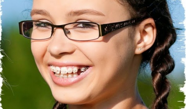 Phương pháp niềng răng không mắc cài Invisalign cho nụ cười tự tin