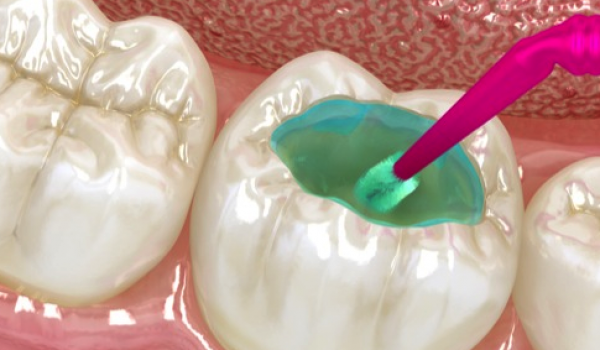 Quy trình trám răng sâu diễn ra như thế nào?