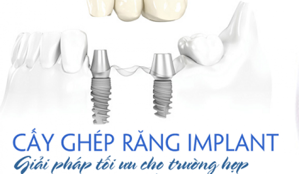 Quy trình và cách chăm sóc răng sau khi cắm ghép Implant