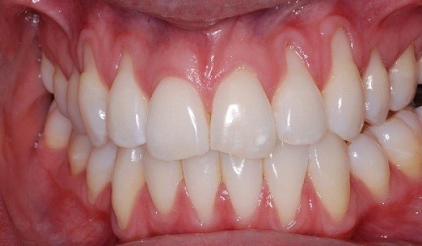Răng bị tụt lợi cần chữa đúng cách