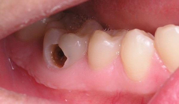 Sâu răng có phải là bệnh lý dễ lây và di truyền?