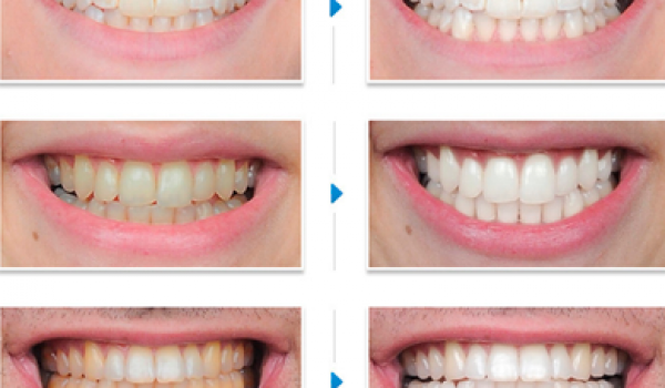 Sự bền đẹp của hàm răng được tẩy trắng từ phương pháp hiện đại