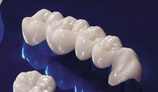 Sự khác biệt của răng sứ không kim loại Cercon