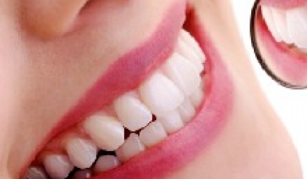 Tại sao bọc sứ răng thưa là sự lựa chọn hoàn hảo?