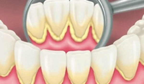 Tại sao phải lấy vôi răng định kỳ tại phòng khám nha khoa?