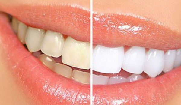 Tẩy trắng răng có khiến mòn men răng?
