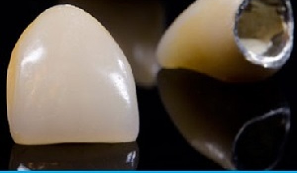 Tìm hiểu về răng sứ Titan