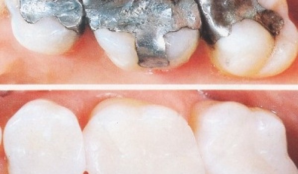 Trám răng có đau không, cách khắc phục trám răng