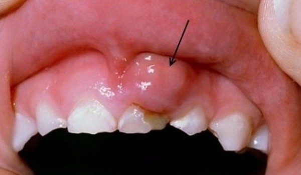 Ung thư miệng, 1 trong 6 bệnh thường gặp ở con người