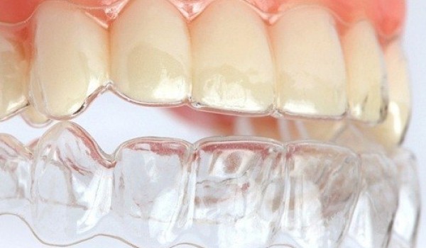 Ưu điểm khiến bạn không nên bỏ qua phương pháp niềng răng không mắc cài