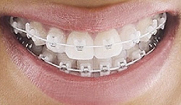 Vì sao nên chọn niềng răng mắc cài sứ