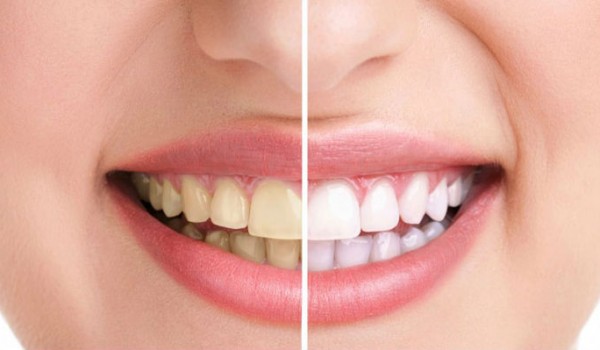 Vôi răng là gì? Tại sao phải cạo vôi răng